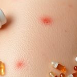 Antybiotyki na trądzik: skuteczność, rodzaje i skutki uboczne