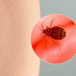 Pasożytnicze choroby skóry: objawy, profilaktyka i leczenie