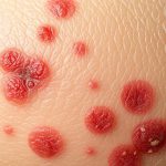 Choroby łojotokowe skóry – przyczyny, objawy i skuteczne leczenie